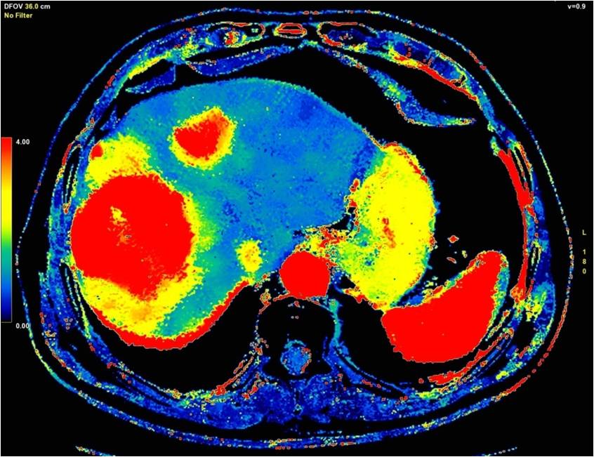 CT-Liver Perfusion for treatment of Hepatocellular Carcinoma